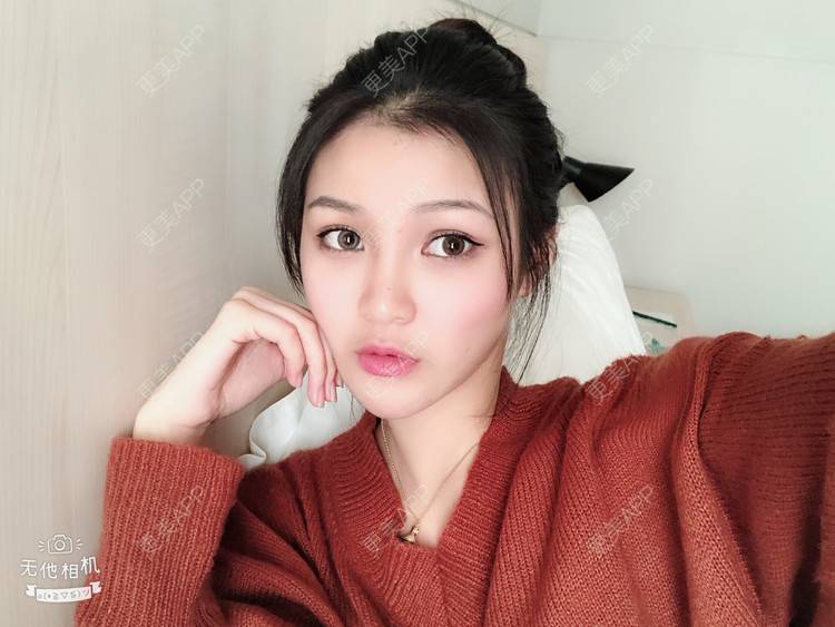 更美 - 更美用户0GOaTxhYaU的鼻部多项经验 | 温州 | 鼻部多项