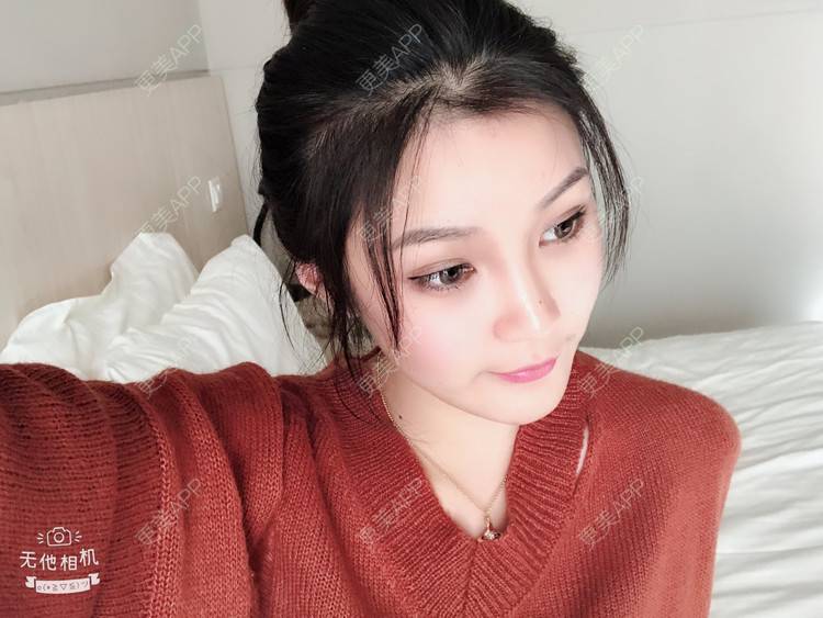 更美 - 更美用户0GOaTxhYaU的鼻部多项经验 | 温州 | 鼻部多项