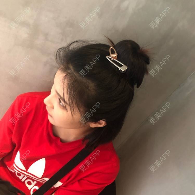 更美 - 更美用户0GOaTxhYaU的鼻部多项经验 | 温州 | 鼻部多项