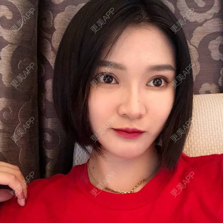 更美 - 更美用户0GOaTxhYaU的鼻部多项经验 | 温州 | 鼻部多项