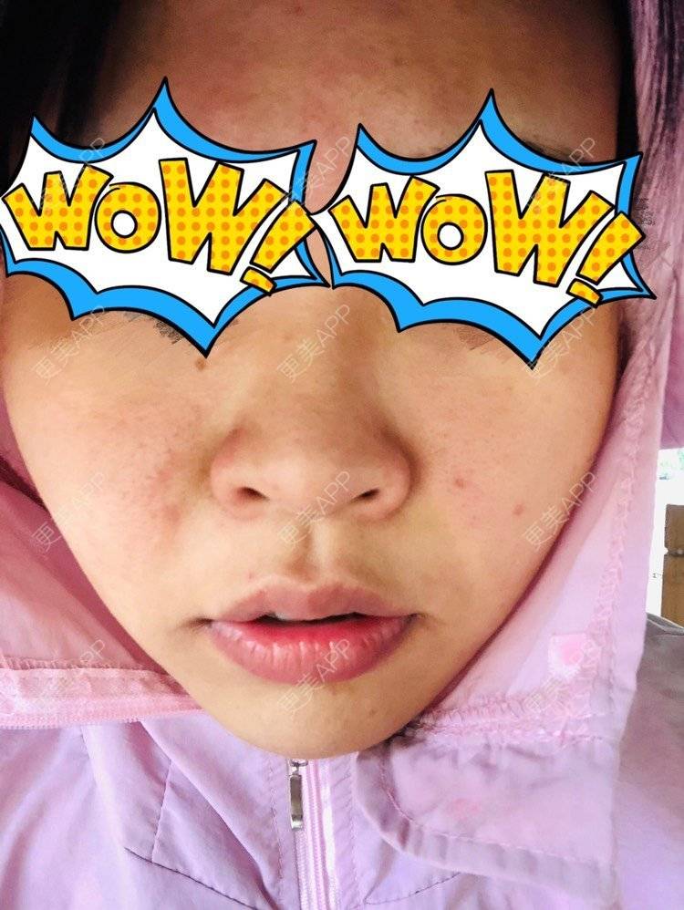 更美 - 天空好像下雨☔️的玻尿酸面部细纹经验 | 玻尿酸面部细纹 | 上海