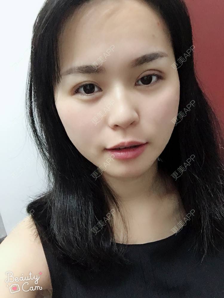 更美 - 更美用户aPZ5J5UfoG的全切双眼皮经验 | 全切双眼皮 | 深圳