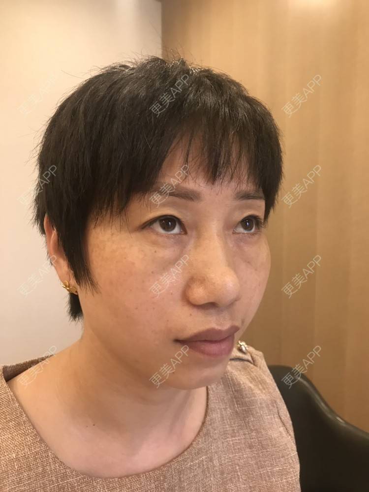 更美 - 踢毽子的小女孩2的外切去眼袋经验 | 外切去眼袋 | 广州