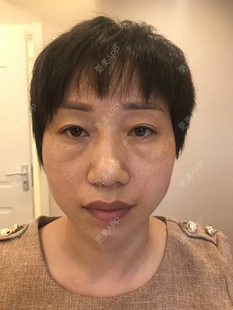 更美 - 踢毽子的小女孩2的外切去眼袋经验 | 外切去眼袋 | 广州