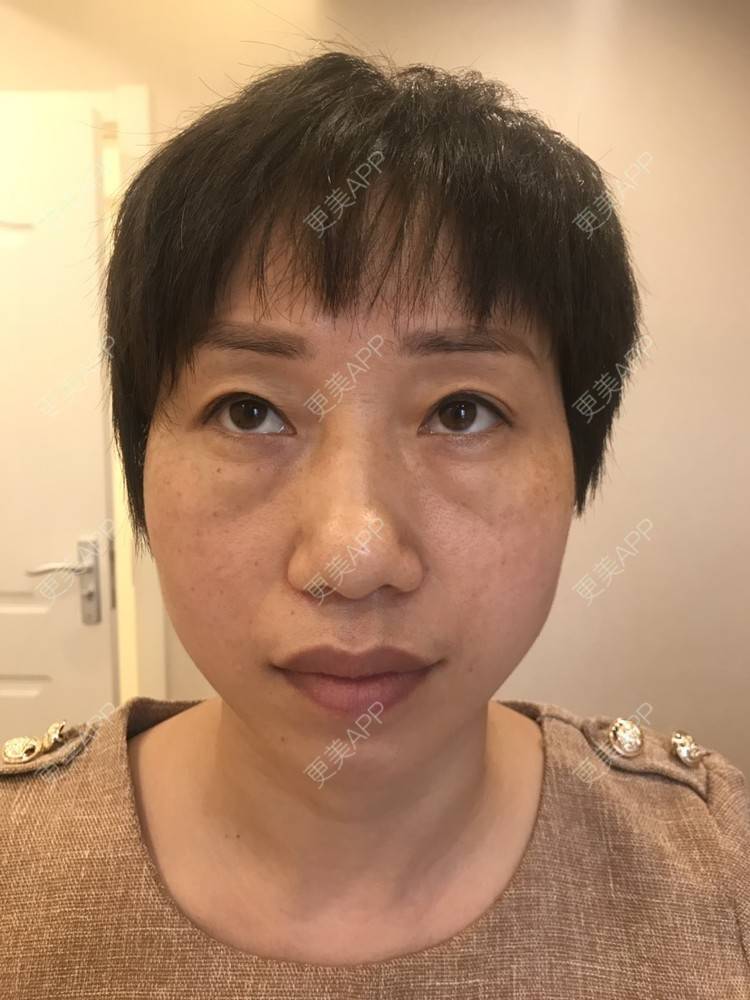 更美 - 踢毽子的小女孩2的外切去眼袋经验 | 外切去眼袋 | 广州