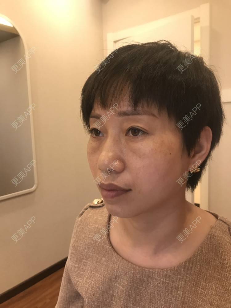 更美 - 踢毽子的小女孩2的外切去眼袋经验 | 外切去眼袋 | 广州