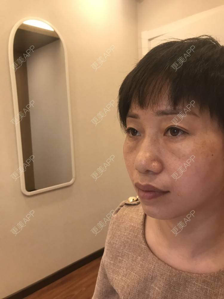 更美 - 踢毽子的小女孩2的外切去眼袋经验 | 外切去眼袋 | 广州