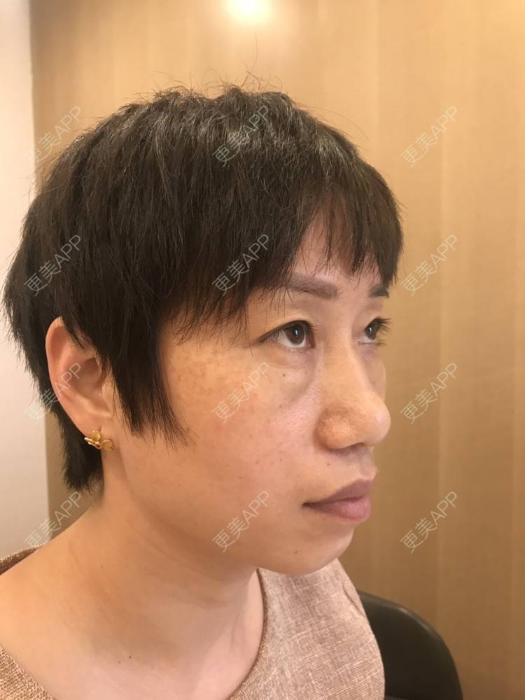 更美 - 踢毽子的小女孩2的外切去眼袋经验 | 外切去眼袋 | 广州