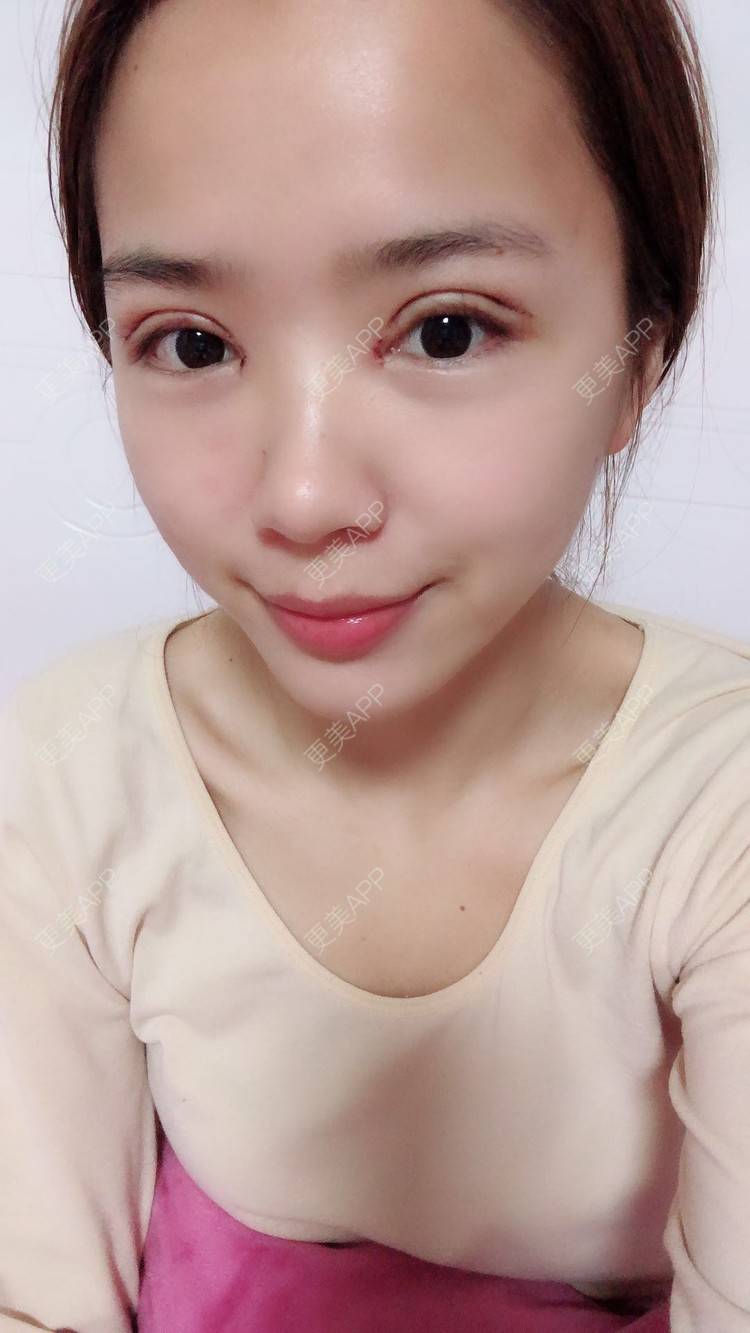 更美 - 如花似玉慕炔的眼部综合日记 | 双眼皮 | 全切双眼皮 | 开内