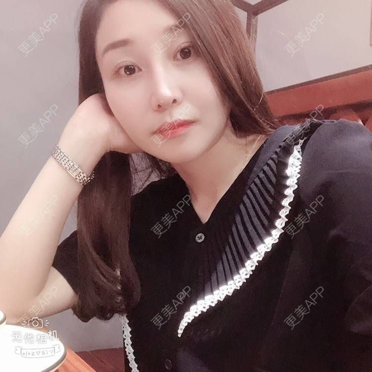 更美 - 蒙蒙噜噜噜的双眼皮修复经验 | 上海 | 双眼皮修复