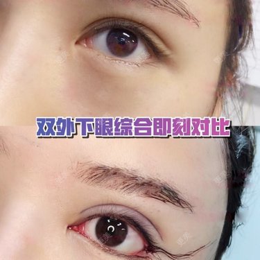 自体脂肪垫下巴