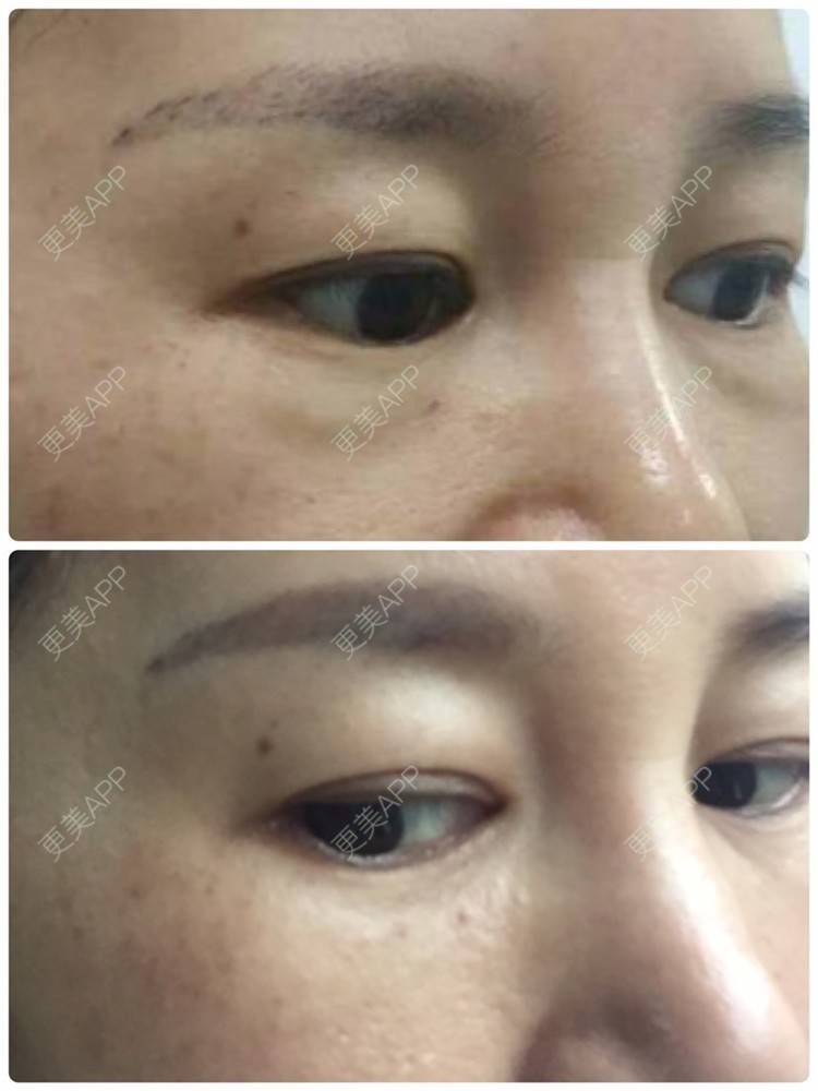 更美 - 更美用户YcZvtkB1Wb的超声提升经验 | 超声提升 | 射频去眼袋