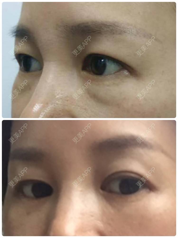 更美 - 更美用户YcZvtkB1Wb的超声提升经验 | 超声提升 | 射频去眼袋