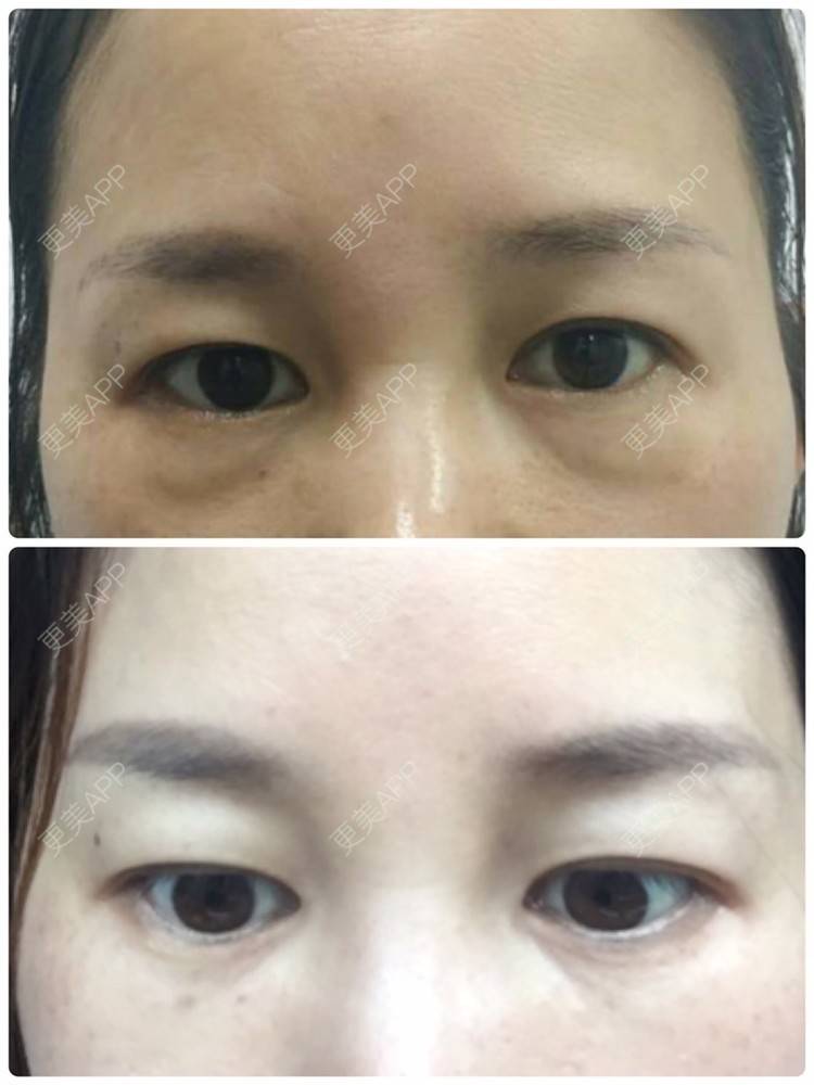 更美 - 更美用户YcZvtkB1Wb的超声提升经验 | 超声提升 | 射频去眼袋