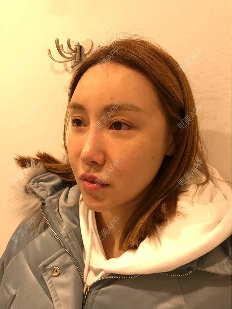 更美 - 素素酱的卧蚕修复经验 | 自体脂肪丰卧蚕 | 自体脂肪全面部填充 | 卧蚕修复