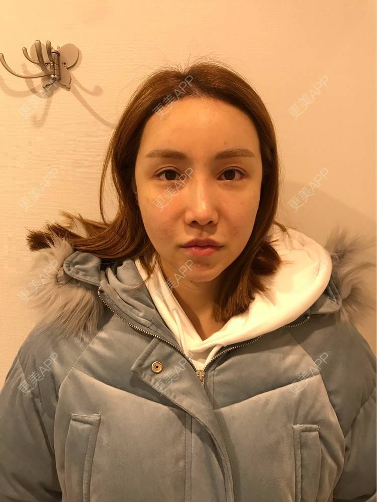 更美 - 素素酱的卧蚕修复经验 | 自体脂肪丰卧蚕 | 自体脂肪全面部填充 | 卧蚕修复