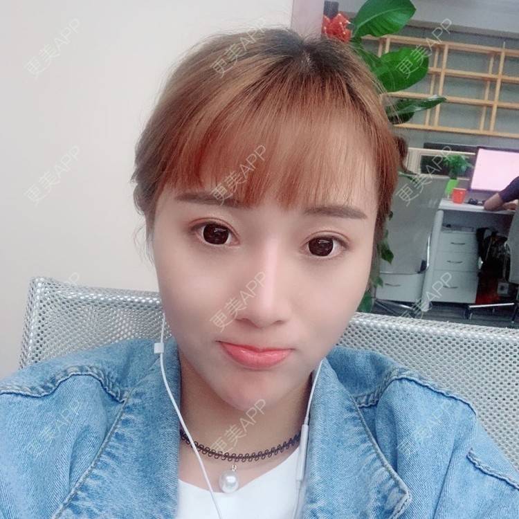更美 - 我的郭靖的隆鼻经验 | 隆鼻 | 硅胶隆鼻 | 耳软骨隆鼻 | 鼻翼缩小 | 鼻部多项 | 自体软骨垫鼻尖 | 温州 | 鼻部综合