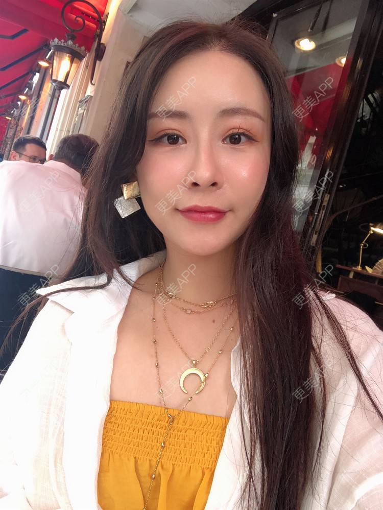 更美 - 兰质慧心的自体脂肪丰苹果肌经验 | 上海 | 自体脂肪丰苹果肌 | 视频日记 | 自体脂肪丰面颊 | 自体脂肪垫下巴