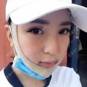 更美 - 更美用户zO6r8Ipolz的吸脂瘦脸经验 | 南昌 | 吸脂瘦脸