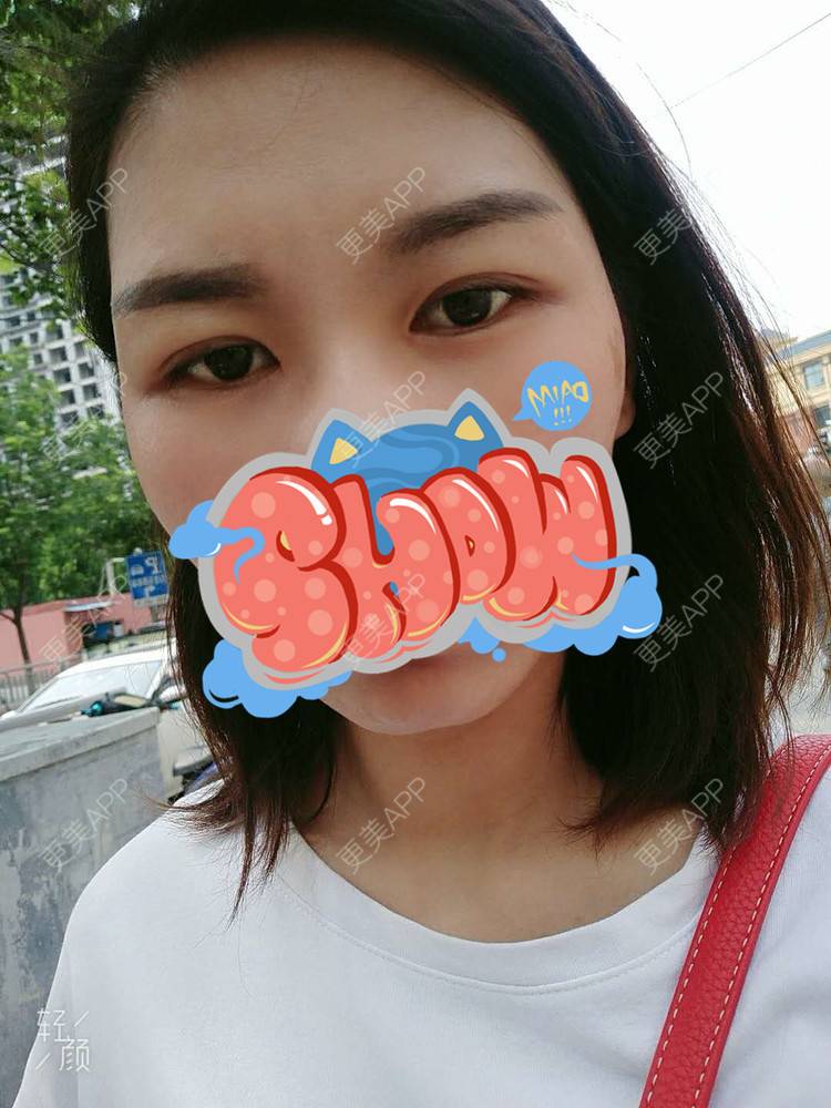 更美 - 杨丽 医生的双眼皮经验 | 双眼皮