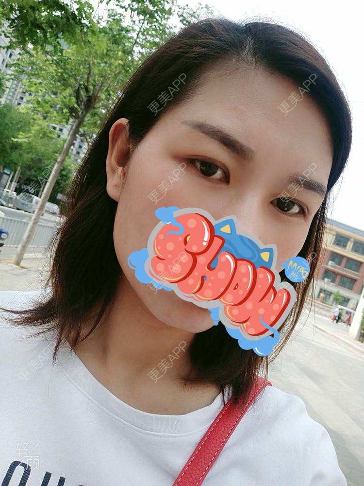 更美 - 杨丽 医生的双眼皮经验 | 双眼皮