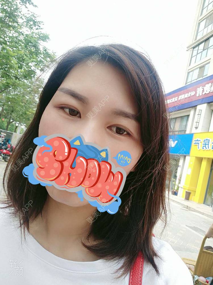 更美 - 杨丽 医生的双眼皮经验 | 双眼皮