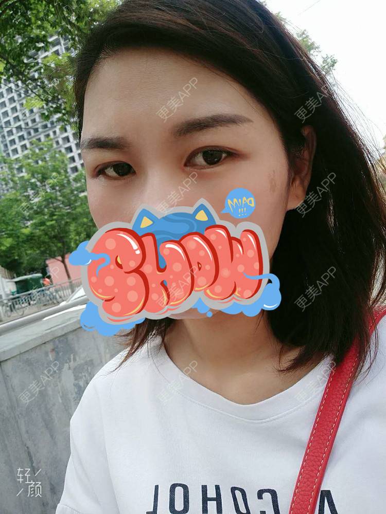 更美 - 杨丽 医生的双眼皮经验 | 双眼皮