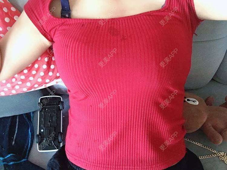 沙拉酱玲儿的胸部下垂矫正日记