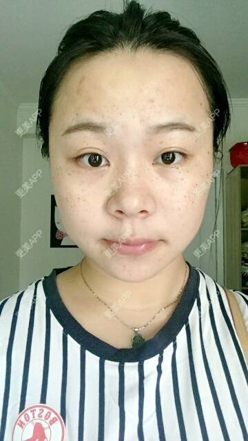 更美 - 情深深，雨濛濛的激光淡斑经验 | 激光淡斑 | 南京