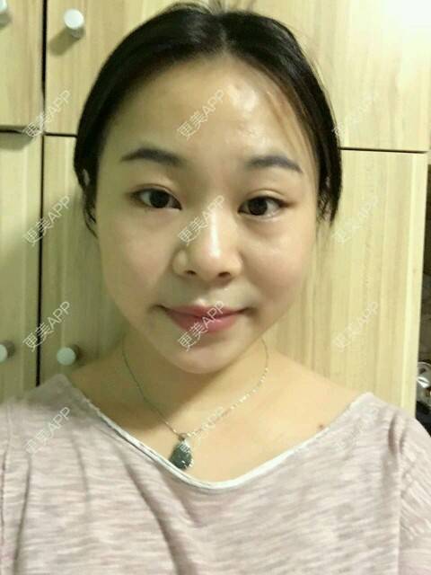 更美 - 情深深，雨濛濛的激光淡斑经验 | 激光淡斑 | 南京