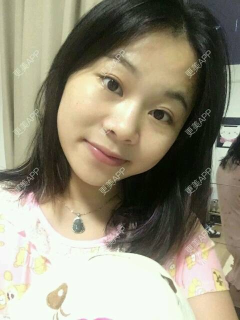 更美 - 情深深，雨濛濛的激光淡斑经验 | 激光淡斑 | 南京