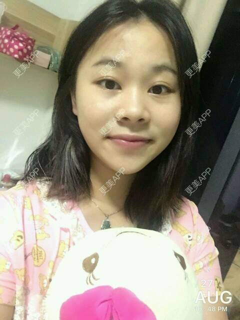 更美 - 情深深，雨濛濛的激光淡斑经验 | 激光淡斑 | 南京