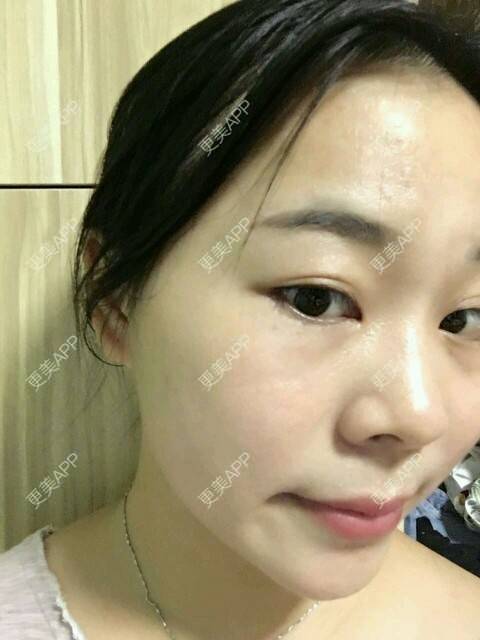 更美 - 情深深，雨濛濛的激光淡斑经验 | 激光淡斑 | 南京