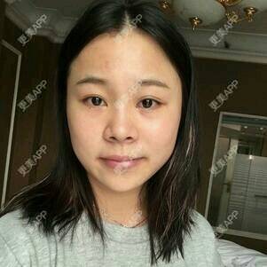 更美 - 情深深，雨濛濛的激光淡斑经验 | 激光淡斑 | 南京