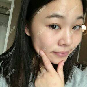 更美 - 情深深，雨濛濛的激光淡斑经验 | 激光淡斑 | 南京