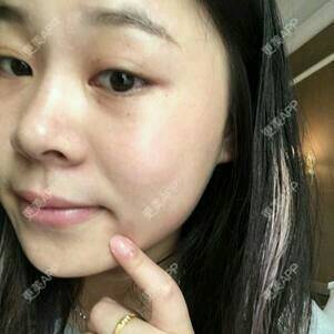 更美 - 情深深，雨濛濛的激光淡斑经验 | 激光淡斑 | 南京