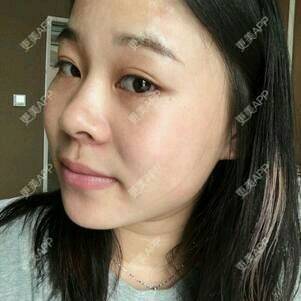 更美 - 情深深，雨濛濛的激光淡斑经验 | 激光淡斑 | 南京