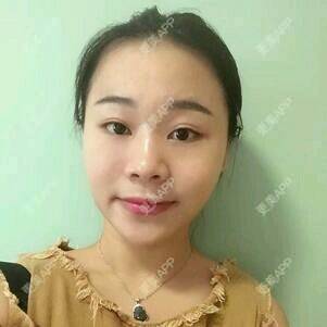 更美 - 情深深，雨濛濛的激光淡斑经验 | 激光淡斑 | 南京