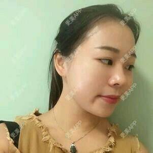 更美 - 情深深，雨濛濛的激光淡斑经验 | 激光淡斑 | 南京