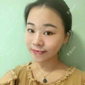 更美 - 情深深，雨濛濛的激光淡斑经验 | 激光淡斑 | 南京