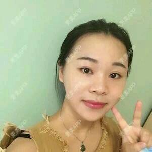 更美 - 情深深，雨濛濛的激光淡斑经验 | 激光淡斑 | 南京