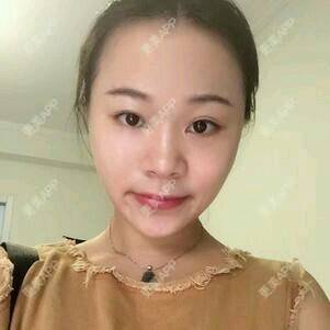 更美 - 情深深，雨濛濛的激光淡斑经验 | 激光淡斑 | 南京