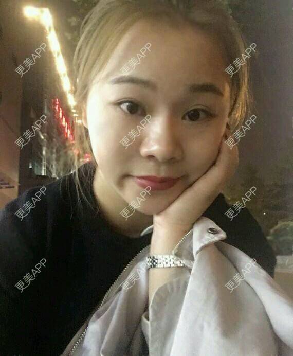 更美 - 情深深，雨濛濛的激光淡斑经验 | 激光淡斑 | 南京