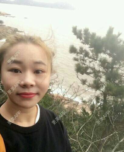 更美 - 情深深，雨濛濛的激光淡斑经验 | 激光淡斑 | 南京