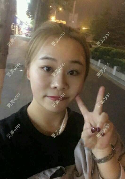 更美 - 情深深，雨濛濛的激光淡斑经验 | 激光淡斑 | 南京