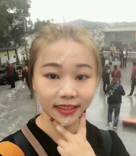 更美 - 情深深，雨濛濛的激光淡斑经验 | 激光淡斑 | 南京