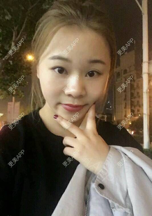 更美 - 情深深，雨濛濛的激光淡斑经验 | 激光淡斑 | 南京