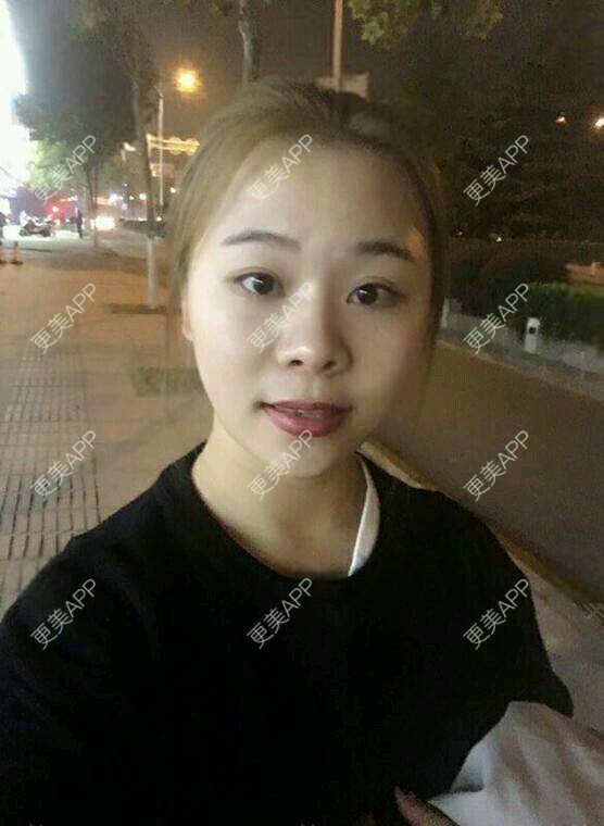 更美 - 情深深，雨濛濛的激光淡斑经验 | 激光淡斑 | 南京