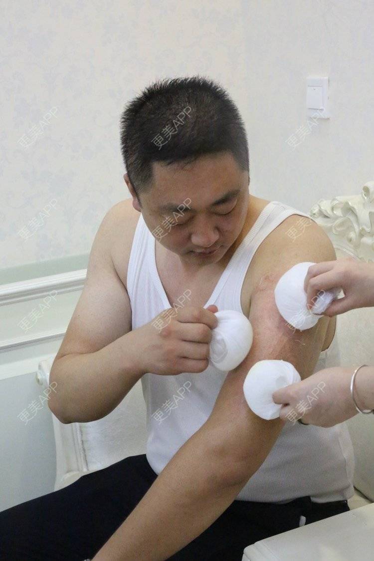 更美 - 无法无天_的皮秒激光经验 | 视频日记 | 激光洗纹身 | 皮秒激光 | 长沙