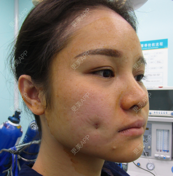酒窝成形前后对比照_更美用户usob6iseak酒窝成形前后对比照_术后221